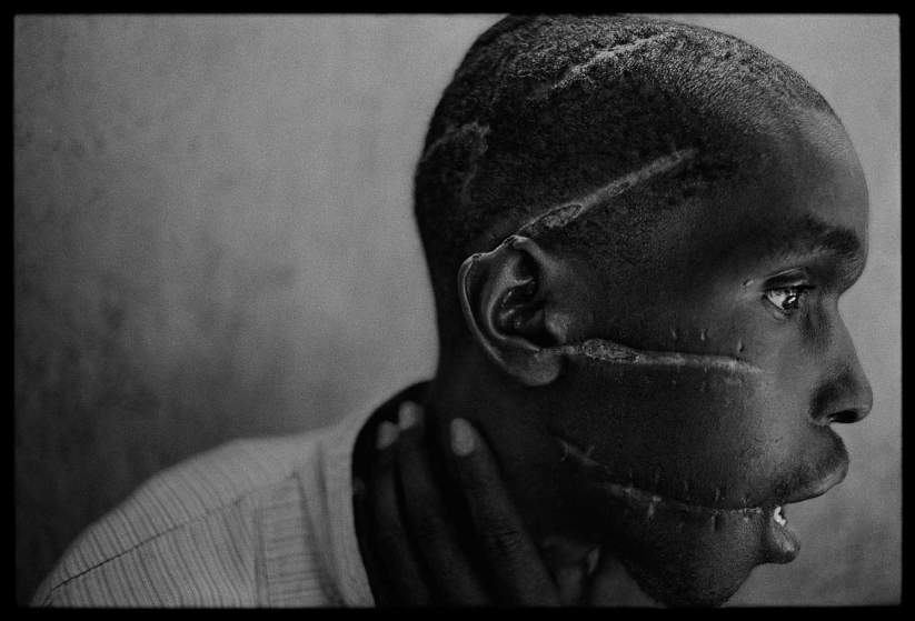 Χτυπήματα από ματσέτες. Πηγή: https://time.com/3449593/when-the-world-turned-its-back-james-nachtweys-reflections-on-the-rwandan-genocide